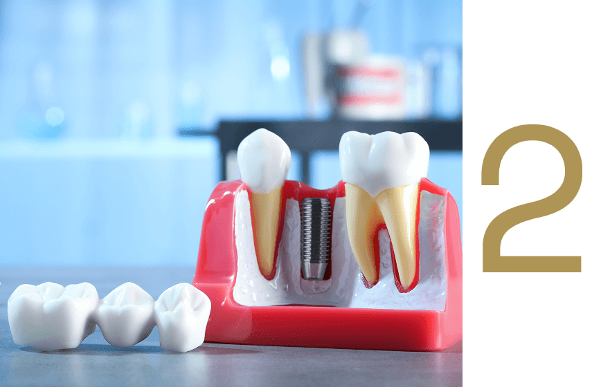 Dental implant model showing implant post and surrounding teeth, illustrating dental implant procedure and treatment options at Advanced Implant & Cosmetic Dentistry.