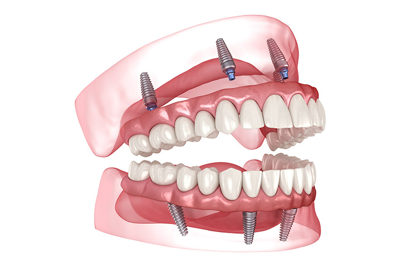 3D illustration of All-on-X dental implants in a full-arch restoration, showcasing dental implants and natural-looking teeth in the upper and lower jaw.